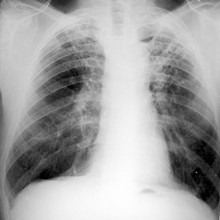 tuberkulez_rentgen